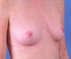 Pravimo, da imajo razli~ne stopnje projekcije oziroma izbo~enosti dojke po operaciji: zmerna, zmerna plus in