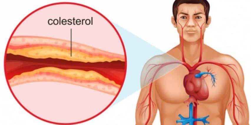 E hënë 4 Dhjetor 2017 15 D y tipat e kolesterolit janë ato, që nëse nuk i ruajmë brenda vlerave, atëherë bëhen shkak për lindjen e sëmundjeve të ndryshme si hipertensioni aritmia, problemet në