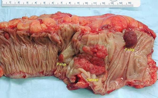 Polipi debelega črevesa in danke so hamartomi juvenilne polipoze, adenoma villosum papilomi. JUVENILNI POLIPI Srečamo pri otrocih v danki in v spodnjem delu debelega črevesa.