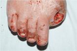However, VAC lone did not enhne wound losure for the ulertion on the tip of his right 1st toe.