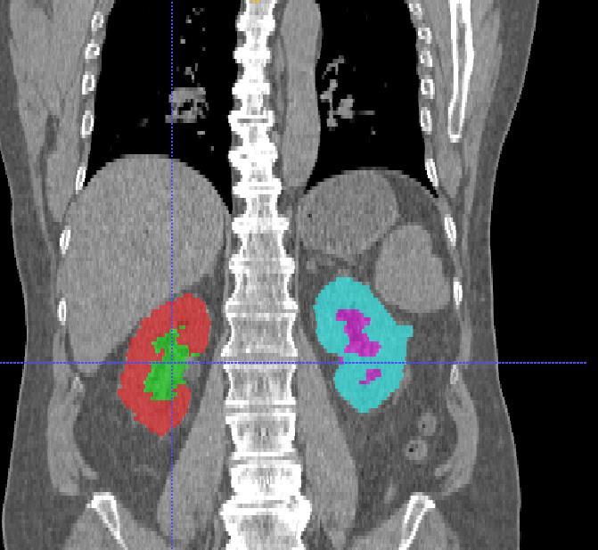 patient with kidneys as volume