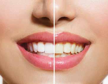 9lasersko 3d beljenje na obeh zobnih lokih spredaj in zadaj 9popolnoma varen postopek 9beljenje zob z gelom, ki ne škoduje zobem in ne draži dlesni 9takojšnji vidni rezultati 9samozavestni nasmešek