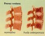 Slika 4: Prevelika izguba kostne mase so porozne kosti in nastop hude osteoporoze (www.ezdravje.