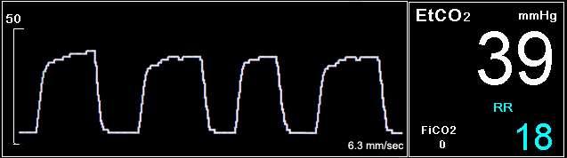 CO2 podaci prikazani na Capnostream monitoru Krivulja CO 2 Vrednosti etco 2, FiCO 2 i brzine disanja Slika 22 - Podaci za CO 2 na Capnostream monitoru Pored toga, monitor može da prikaže podatke za