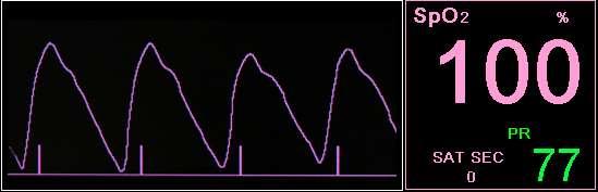 Traka krivulje SpO 2 (pletizmograf) SpO 2 Sat Seconds Brzina pulsa Slika 24 - Podaci za SpO 2 na Capnostream monitoru - Standardni ekran Na standardnom početnom ekranu sa omogućenom IPI vrednošću