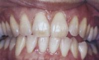 38 KAKO ZDRAVITI Beljenje zob: varno do svetlejšega nasmeha marec 2010 NAŠA LEKARNA 39 Tipi in narava madežev/obarvanj zob Vzrok in izvor zabarvanja zob vpliva na hitrost in način odstranitve.