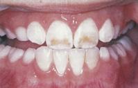 42 Beljenje zob: varno do svetlejšega nasmeha marec 2010 NAŠA LEKARNA 43 verjetnost nastanka zunanje resorpcije korenine in pojava občutljivosti zoba), nosečnice in matere, ki dojijo (zaradi
