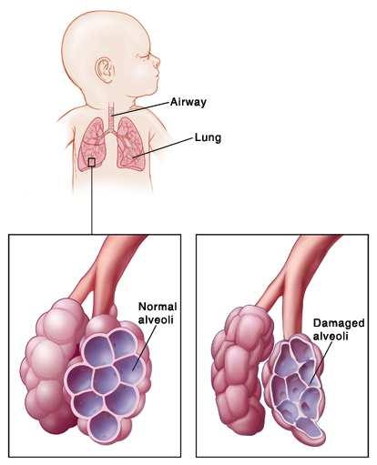 Kronična bolest pluća nedonoščeta: bronhopulmonarna displazija (BPD) Bolest nastaje kod vrlo niske porođajne mase.