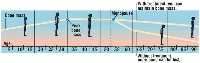 DIJETA KOD OSTEOPOROZE Osteoporoza se definira kao gubitak gustoće, mase i čvrstoće kostiju, tj. stanjivanje i slabljenje kostiju.