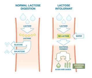 Slika 72 Netolerancija na laktozu (Internet) Nealergijske reakcije na hranu mogu se javiti kao rezultat drugih zdravstvenih problema.