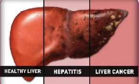 Masti treba jetrenom bolesniku ograničiti na najmanju moguću mjeru, s time da su životinjske masti u potpunosti zabranjene.