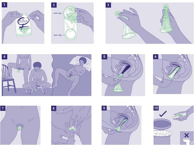 Tokom seksualnog akta kondom se može okretati lijevo-desno i gore-dole, ali je važno samo da je penis pokriven. Ako penis izađe van kondoma (ispod ili iznad njega), odmah prekinuti spolni akt.
