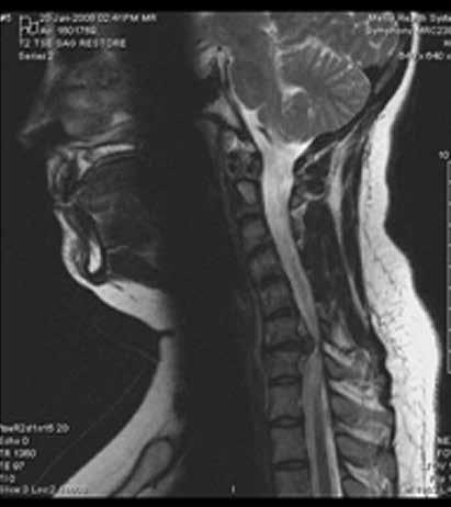 GLAS ZDRAVLJA OPERACIJSKA TEHNIKA PREDNJE INTERKORPORALNE FUZIJE ALOGRAFTOM KOD VRATNE KRALJEŽNICE Bolovi u vratu najčešće su posljedica degenerativnih promjena vratne kralježnice kojima su zahvaćeni