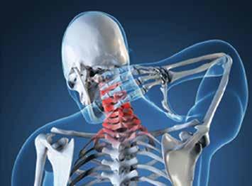 Radikularna bol javlja se u distribuciji živčanih korjenova pojedinih dermatoma, a može biti posljedica hernijacije i.v. diska ili kompresije pojedinih korjenova osteofitima.