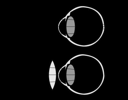 Dalekovidnost je također i stanje je u kojem oko, sa starenjem, pokazuje progresivno smanjenje sposobnosti da se akomodira na objekte u neposrednoj blizini.