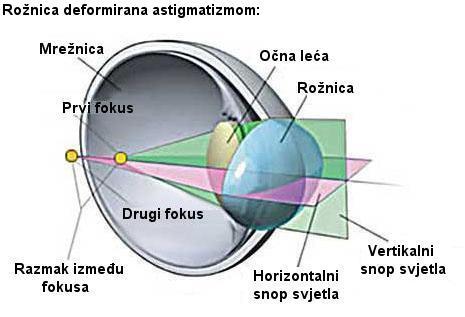 Slika 14. Rožnica bez astigmatizma [12] Slika 14. prikazuje zdravu rožnicu bez astigmatizma. Zrake svijetlosti tu lome oba meridijana(horizontalni i vertikalni) jednako.