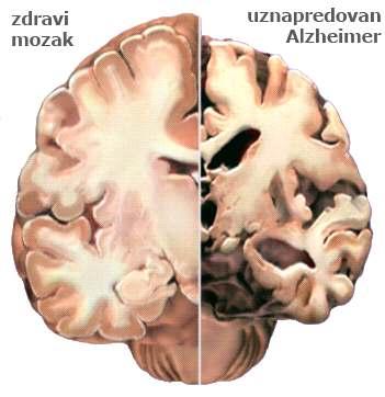 Slika 2.2.1. Promjena mozga kod Alzheimerove bolesti Izvor:http://www.alz.org/ Slika 2.2.1. prikazuje razliku između zdravog mozga i mozga koji je pod Alzheimerovom bolešću.