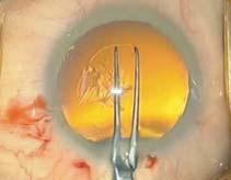 capsulorhexis. CORNEAL INCISION or SCLERAL TUNNEL Tip to pivot length either 10.0mm or. Designed specifically for cornea or scleral placed incisions.