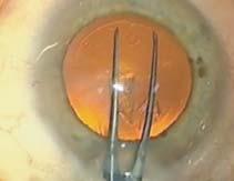 8mm corneal incision 2.2mm corneal incision SMALL INCISION SIZE Designed to fit comfortably through any incision down to 1.8mm. Dr O.