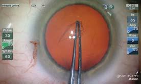 9mm Pointed Tips Increased curvature of forceps shafts prevent corneal deformation When entering through a corneal incision the increased curvature