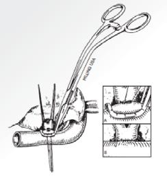 AORTIC Aortic Vascular Clamps BAHNSON AORTA CLAMP 353623 To occlude the aorta during a median sternotomy in the adult. Angle of handle puts it out of the way.