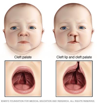 is a separation of the upper lip and underlying muscle Cleft Palate- is a opening of