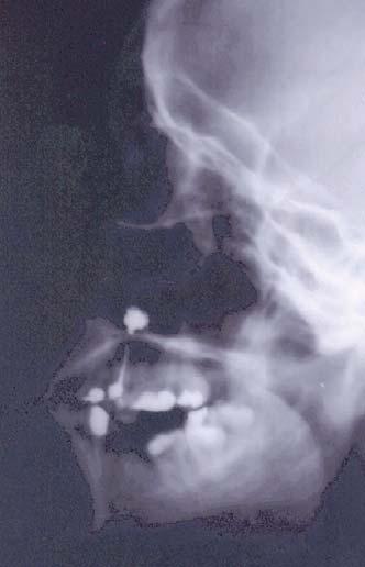 Vol. 11 - Broj 1 APOLLINEM MEDICUM ET AESCULAPIUM januar-mart/2013. Zub u desnom maksilarnom sinusu jatrogene prirode. Profilni tomogram desnog maksilarnog sinusa.