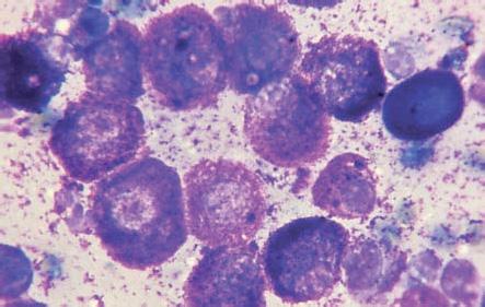 Makroskopický obraz nádoru spolu s cytologickým nálezom zhlukov uniformných epiteliálnych buniek, ktoré môžu mať zľahka vyššiu bunkovú denzitu a trošku chaotické usporiadanie, sú konzistentné s