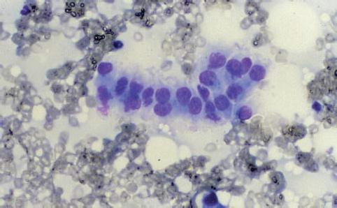 Klinická cytológia spoločenských zvierat: Časť II. Cytológia podkožných opuchov, kožných nádorov a kožných lézií - E. Teske Obr. 16 Typický lineárny zhluk buniek z aspirátu nádoru bazálnych buniek.