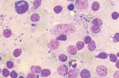 monocyty. Prehľad rôznych typov buniek nachádzajúcich sa v normálnej lymfatickej uzline je v tab. 1.