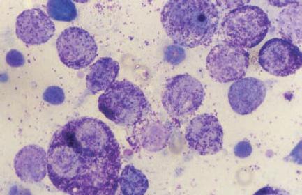 EJCAP - Vol. 18 - Issue 2 October 2008 Obr. 10 Metastázy mastocytómu do lymfatickej uzliny. Početné mastocyty sú rozdielnej veľkosti, majú vystupujúce jadierka a môžeme pozorovať dvojjadrové bunky.