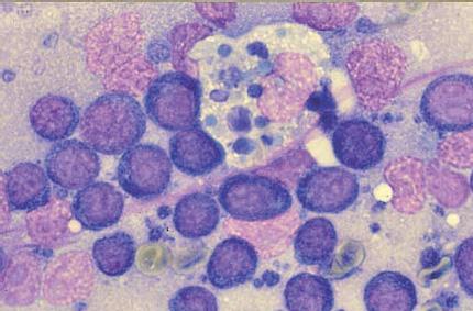 EJCAP - Vol. 18 - Issue 2 October 2008 Obr. 15 Centroblastický/centrolytický lymfóm. Zmiešaná populácia veľkých centroblastov, malých centrocytov (lipnúce bunky) a lymfocytov.