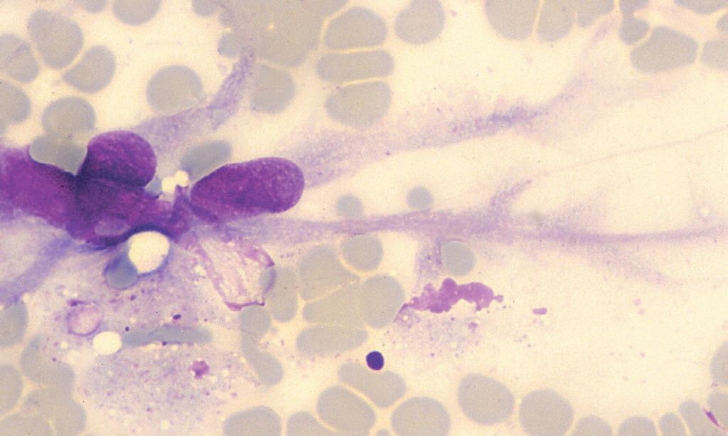 Niekedy, ako napríklad pri endokrinných nádoroch, sa pri rozťahovaní náteru cytoplazma oddelí od jadra a v preparáte potom pozorujeme len nahé jadrá.