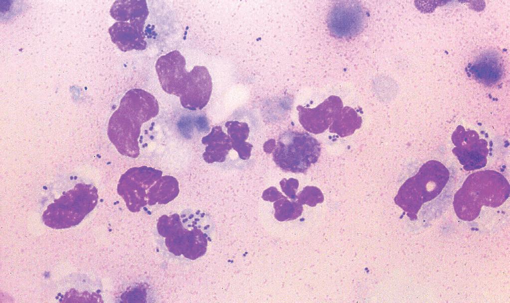 Klinická cytológia spoločenských zvierat: Časť I. Úvod - E. Teske Obr. 8 Akútny septický zápal s niekoľkými neutrofilmi s vnútrobunkovými baktériami a karyolýzou.