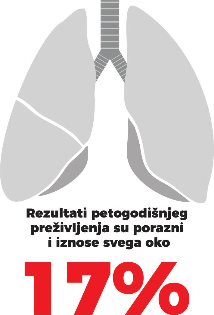 KARCINOM PLUĆA Karcinom (rak) pluća nastaje nekontrolisanim umnožavanjem malignih ćelija u plućima.