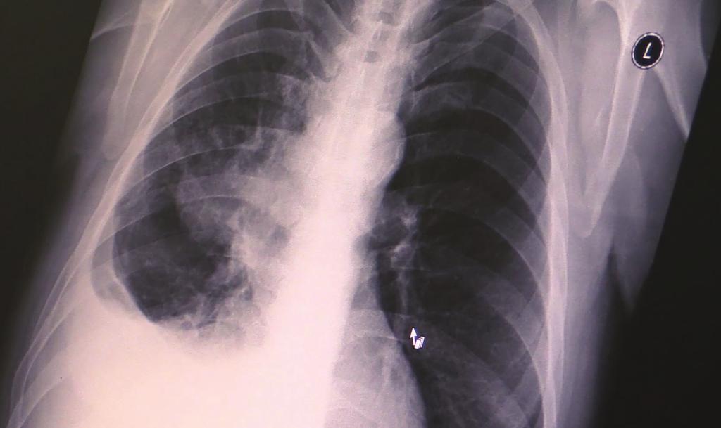 SIMPTOMI Simptomi karcinoma pluća su većinom nespecifični i vrlo često mogu biti zanemareni od strane pacijenta.