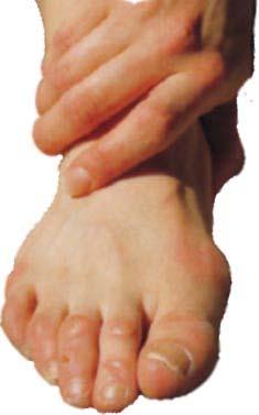 Do you have a loss of feeling in your feet, or do you often get wounds on your feet?