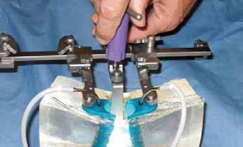 Attach desired Hook Straight, Fan Blade, or Counter Retractor Blade to the Pivoting Center
