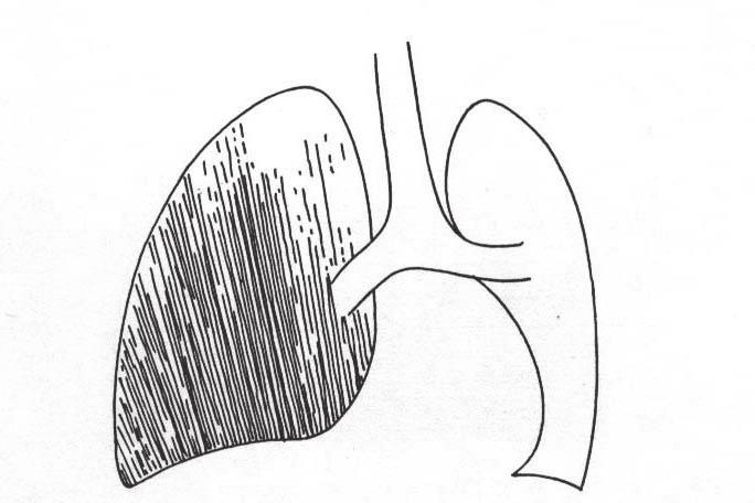 110 Plu na tuberkuloza kod odraslih Slika 27 Veliki pleuralni izliv sa desne strane. Obratite pažnju na traheju, srce i medijastinum koji su povu eni ulevo 2.3 