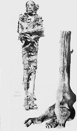 O deformacijah je veliko več dokazov iz časa starodavnega Egipta predvsem zaradi trajnosti v mumificiranih ostankih v kapelicah grobnic, nasprotno pa o njih ne pišejo medicinski papirusi.