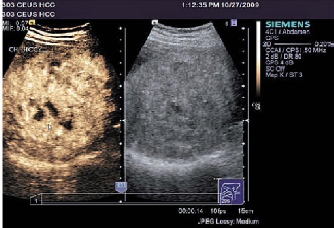 7 1.2.1. Siêu âm cản âm Những năm gần đây, sự giới thiệu của siêu âm cản âm (Contrast enhanced Ultrasound) trong thực hành lâm sàng bệnh lý gan mật đã làm thay đổi giá trị của phương pháp này trong