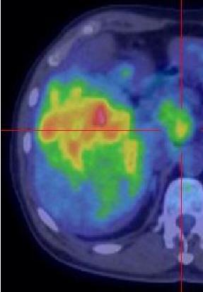 Khối u gan và hạch bắt FDG không đồng nhất trên hình ảnh PET (hình giữa) và trên hình ảnh PET/CT (hình bên phải) (Nguồn: Lê Ngọc Hà [7]) 1.2.5.