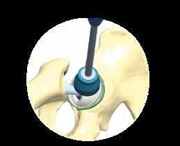 Figure 21 Example Reamer = 54mm Trial cup = 54mm Definitive implant = 52mm