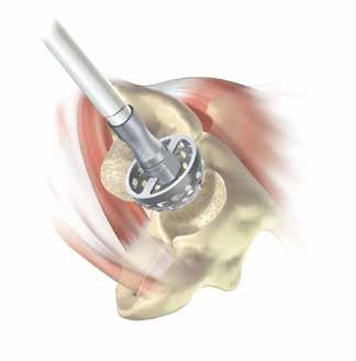 3. Acetabular Reaming It is important to start reaming with the smallest diameter grater reamer available, perpendicular to the acetabulum, in order to find the true acetabular floor.