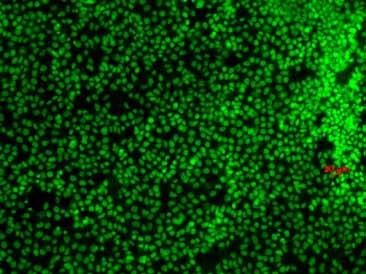 Foto: MatijaVeber Človeške embrionalne karcinomske celice Vir: teratokarcinomi Embrionalne karcinomske celice so bile prve odkrite pluripotentne celice.