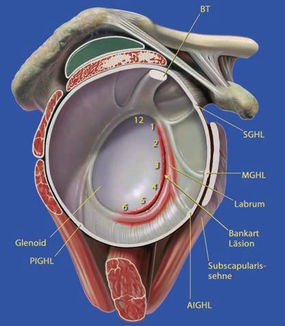 Anatomic reconstruction of the labrum-capsule complex in the case of a Bankart lesion Diagram of a