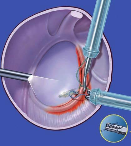 Removal of the inferior thread through the anterior-superior cannula.