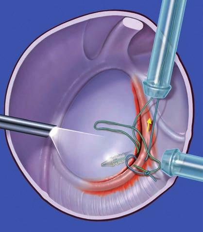 guiding out of the carrier thread through the anterior-inferior cannula.