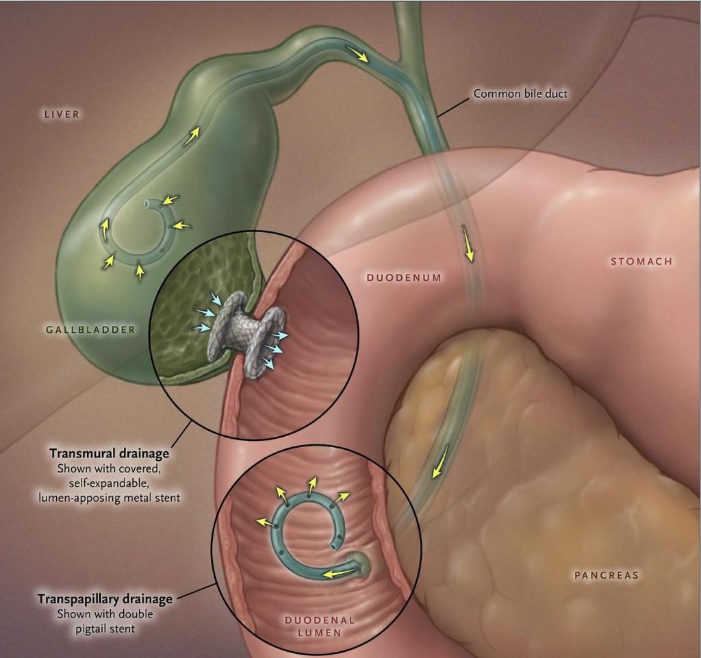 EUS Gallbladder Background EUS-guided lumenapposing stents (LAMS) currently being used for palliative