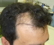 implementing over 250 hair transplant sessions per year.